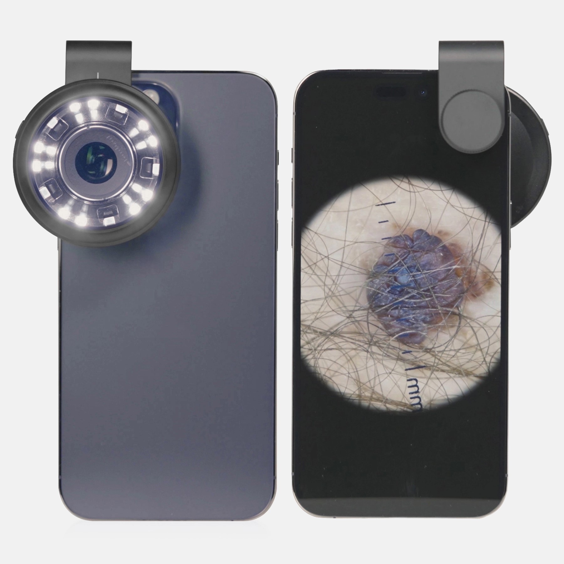 Celular com câmera dermatoscópica acoplada, visão frontal e traseira.