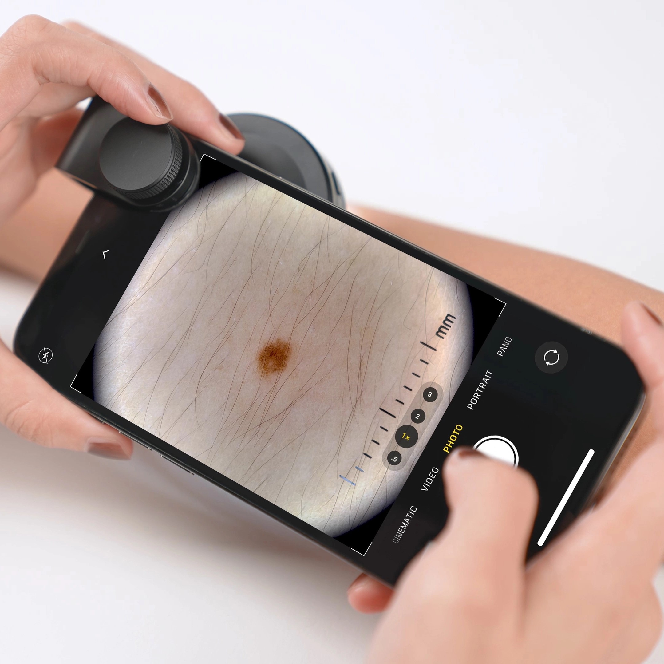 Exame dermatoscópico realizado diretamente com o smartphone.